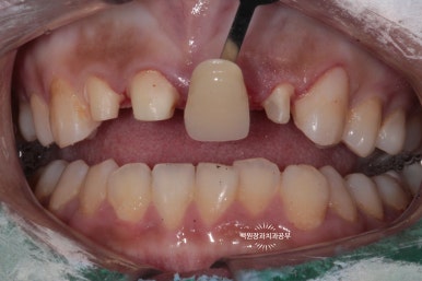 앞니에 잇몸염증과 충치가 심해요. 앞니 지르코니아 크라운 성공 후기. 치료과정/치료기간/비용/전후비교. 관련 이미지 18