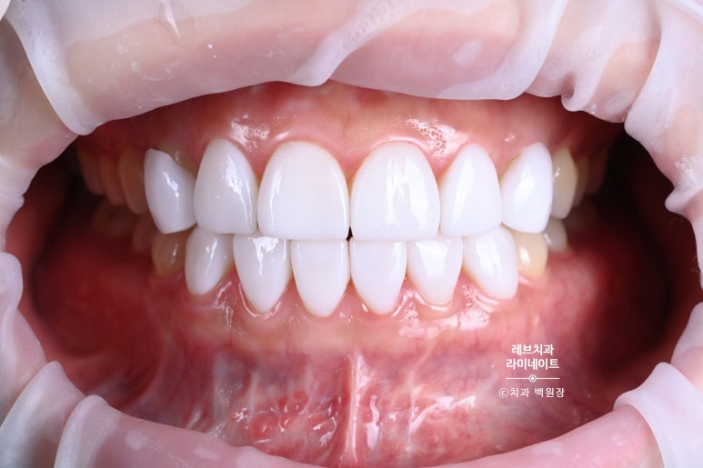 레브네이트 베이직. 치아미백과 치아교정을 한번에! 치아삭제 사진 있음. 신사역 치과 앞니라미네이트 모델/비용/후기. 관련 이미지 14