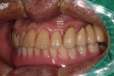 아래 어금니 임플란트 6개면 틀니를 안써도 됩니다.  치주염 전문 착한치과. 치료기간/임시치아과정/후기/비용. 관련 이미지 5