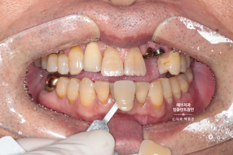 앞니 부러짐? 뽑고 바로 임플란트 + 뼈이식. 앞니 흔들림? 뽑고 1달 기다리고 임플란트 + 뼈이식. 신사역 치과 후기/비용/과정. 관련 이미지 17