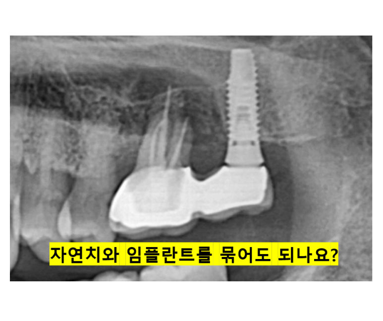 치아와 임플란트를 연결하면 치아가 망가집니다. 발치 동시 치조골 이식 후 임플란트. 치료과정/치료기간/비용/후기. 관련 이미지 1