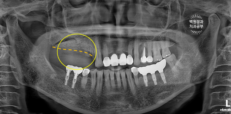 60대 임플란트 주변에서 고름이 나와요. 실패한 임플란트 제거 후 재수술. 덴티움 뼈이식재를 사용한 치조골 이식술. 관련 이미지 9