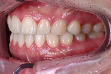 신사역 라미네이트, 잘하는 치과의 치료과정과 재료.설명.비용.후기. 관련 이미지 3