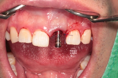 앞니 머리가 기둥째 부러졌어요. 발치 동시 뼈이식 오스템 BA 임플란트. 치료과정/치료기간/비용/후기. 압구정 치과. 관련 이미지 11