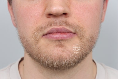 A European Patient at [Rev Dental Clinic] near Sinsa Station in Seoul Wanted Front Tooth Decay Treated with an EMAX All-Ceramic Crown. image 5