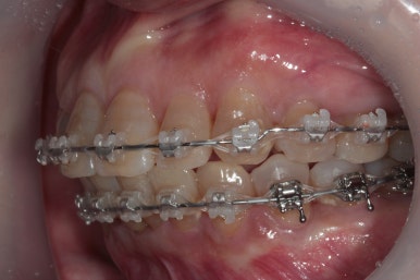 삐뚤어진 앞니를 8개월만에 가지런하게 만드는 50대 성인부분교정. 신사역 교정치과. 치료과정/기간/비용. 관련 이미지 12