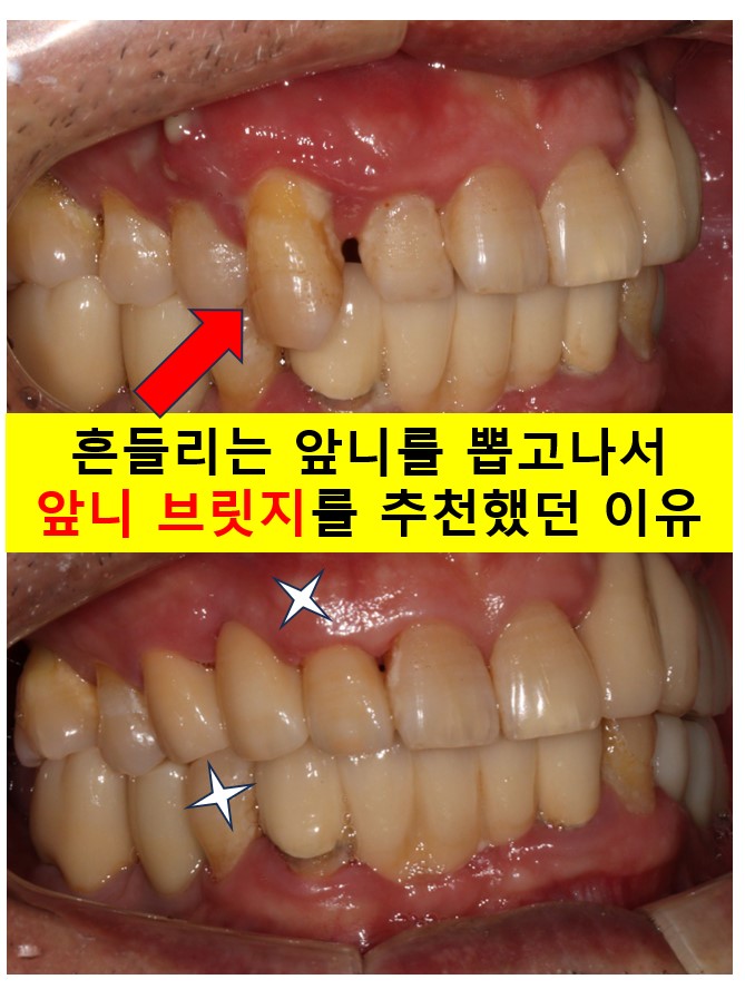치주염 앞니 잇몸 염증으로 흔들릴 때 - 앞니 브릿지와 임플란트 장단점, 비용. 치료과정과 결과를 눈으로 보여주는 치과. 관련 이미지 1