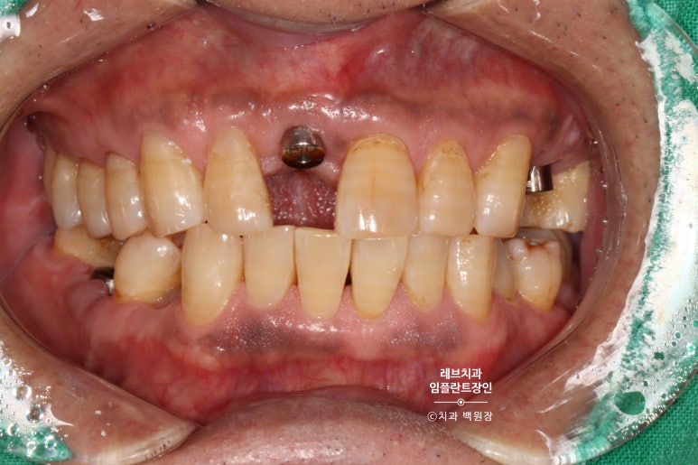 앞니 부러짐? 뽑고 바로 임플란트 + 뼈이식. 앞니 흔들림? 뽑고 1달 기다리고 임플란트 + 뼈이식. 신사역 치과 후기/비용/과정. 관련 이미지 7