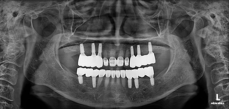 어금니 여러개가 없어요. 전체 임플란트와 앞니 크라운을 통한 완벽한 재건!! 치료과정/치료기간/비용/후기. 관련 이미지 35