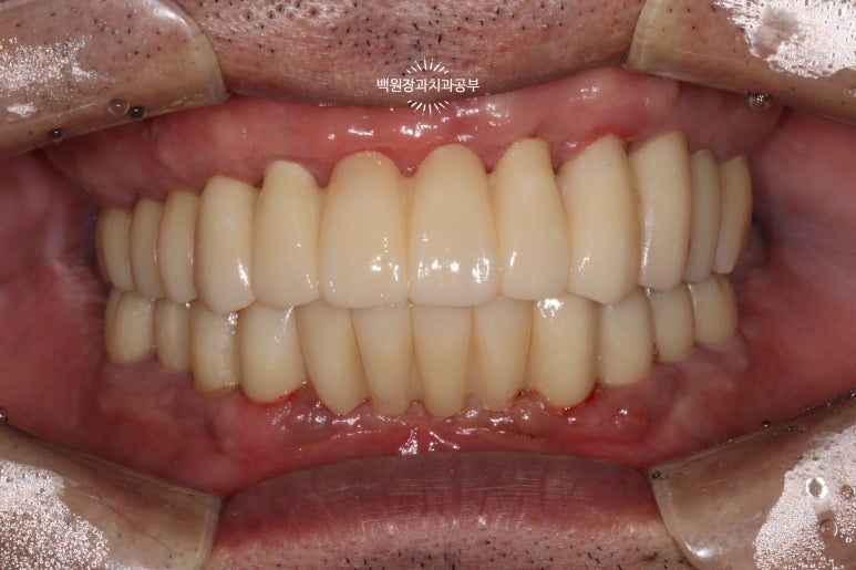 오스템임플란트 네비게이션 전체 임플란트 치료일기. 치료과정/치료기간/비용/솔직후기. 관련 이미지 37