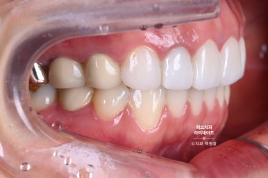 신사역 퍼스널컬러 맞춤 치과. 전담 세라미스트가 앞니 크라운과 라미네이트를 만들어 드립니다. 관련 이미지 4