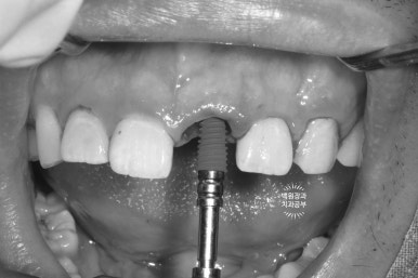 앞니 머리가 기둥째 부러졌어요. 발치 동시 뼈이식 오스템 BA 임플란트. 치료과정/치료기간/비용/후기. 압구정 치과. 관련 이미지 7