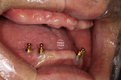 불편한 틀니를 아직도 쓰시나요? 전체 임플란트 치료비용/치료기간/치료과정. 관련 이미지 5