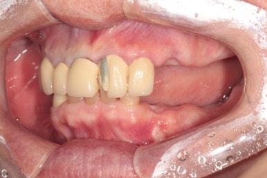 어금니 여러개가 없어요. 전체 임플란트와 앞니 크라운을 통한 완벽한 재건!! 치료과정/치료기간/비용/후기. 관련 이미지 4