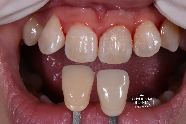 신사역 치과. 아나운서 면접 전 앞니 벌어진 공간을 라미네이트로만 해결할 수 있었던 사연.. 관련 이미지 14
