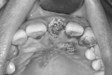 앞니 머리가 기둥째 부러졌어요. 발치 동시 뼈이식 오스템 BA 임플란트. 치료과정/치료기간/비용/후기. 압구정 치과. 관련 이미지 9