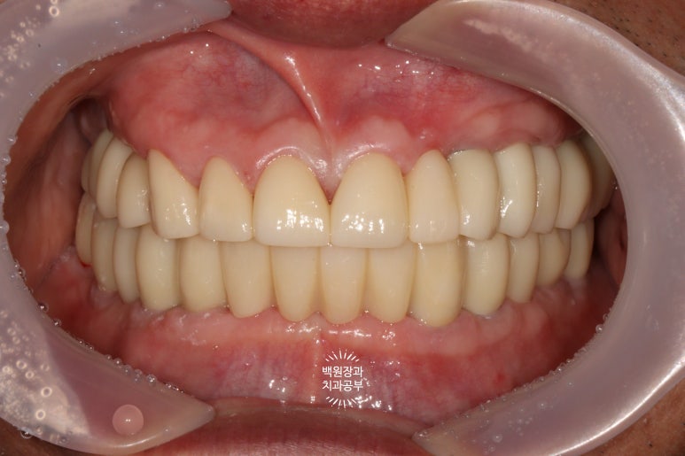 임플란트장인의 마음으로 8개월간 전체임플란트 완성. 치주과 전문의. 관련 이미지 27