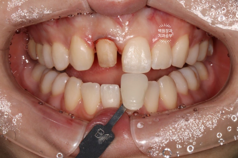 잇몸 성형과 치아미백 그리고 지르코니아 20대 앞니 크라운 치료. 치료과정/기간/비용. 관련 이미지 11