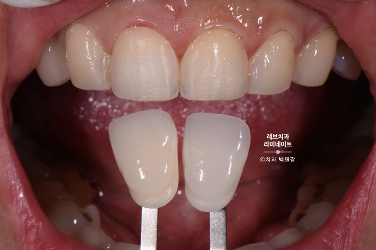 레브네이트 베이직. 치아미백과 치아교정을 한번에! 치아삭제 사진 있음. 신사역 치과 앞니라미네이트 모델/비용/후기. 관련 이미지 12