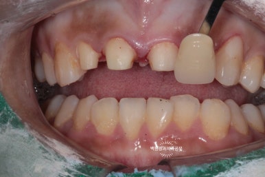 앞니에 잇몸염증과 충치가 심해요. 앞니 지르코니아 크라운 성공 후기. 치료과정/치료기간/비용/전후비교. 관련 이미지 19