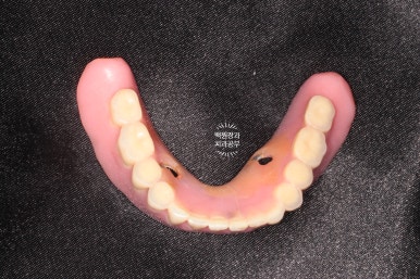 임플란트틀니 - 오버덴쳐. 오스템BA임플란트 이용한 최고의 가성비 치료. 치료과정/치료기간/비용/후기. 관련 이미지 8