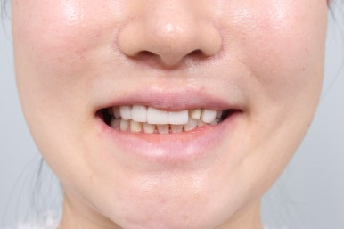 신사역 다른치과 앞니 라미네이트 하나 깨짐. 재치료 잘하는 레브치과의 레브네이트로 해결!! 관련 이미지 8