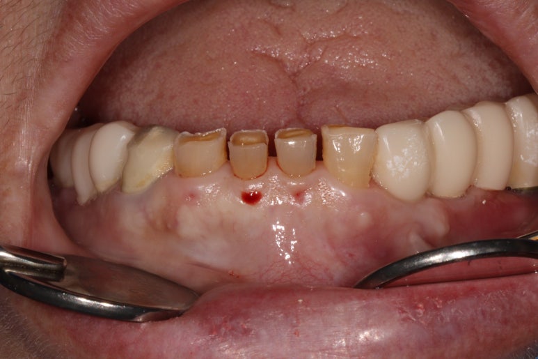 어금니 여러개가 없어요. 전체 임플란트와 앞니 크라운을 통한 완벽한 재건!! 치료과정/치료기간/비용/후기. 관련 이미지 14