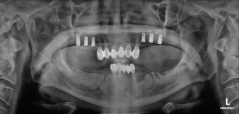 잇몸 염증 고름이 심했던 부위 - 만성치주염 진단하고 임플란트로 깔끔하게 치료! 신사역 치과 관련 이미지 16