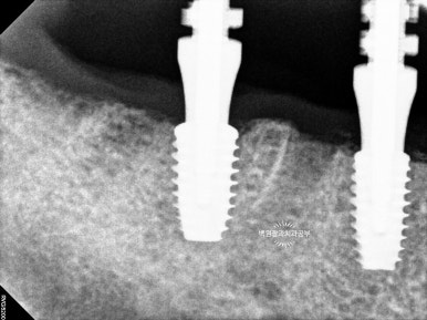 오스템임플란트 네비게이션 전체 임플란트 치료일기. 치료과정/치료기간/비용/솔직후기. 관련 이미지 15