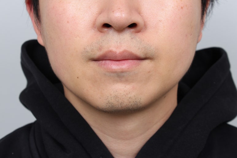 서울 신사역 [레브치과] 이갈이 보톡스 - 치과에서 코어톡스로 - 3개월 후기/주기/용량/가격. (의사작성) 관련 이미지 1