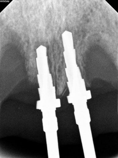 앞니가 풍치로 흔들거려요. 심한 치주염인데 임플란트 가능할까요? 치료과정/치료기간/비용/성공후기. 신금호역 치과 추천. 관련 이미지 19