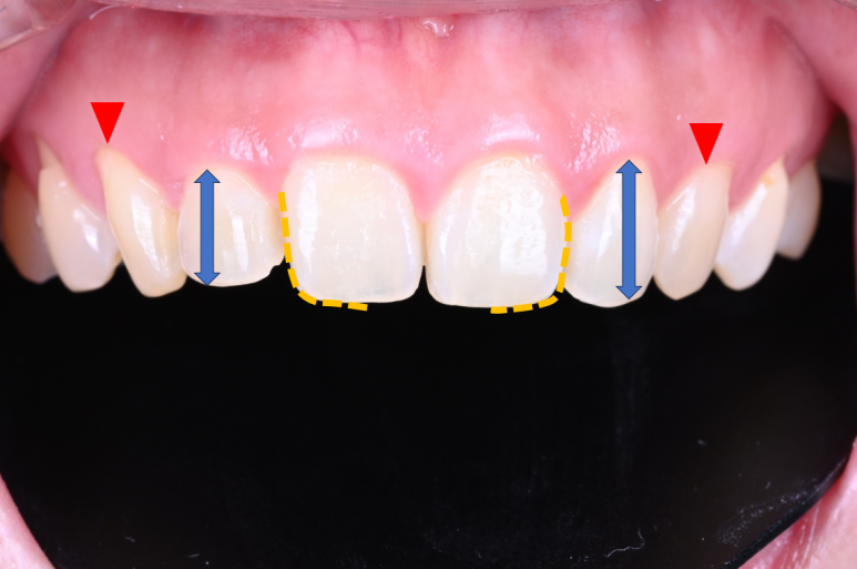 신사역 라미네이트. 결혼식 전 앞니 고민, 얇은 세라믹 레브네이트로 해결! 관련 이미지 8