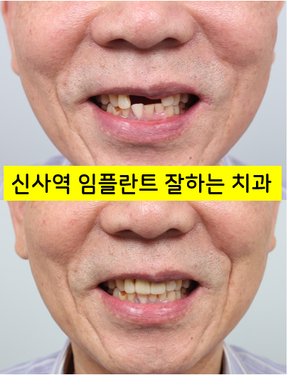 신사역 앞니 임플란트 잘하는 레브치과. 가격/비용/사진/후기. (프로포폴 수면가능) 관련 이미지 1