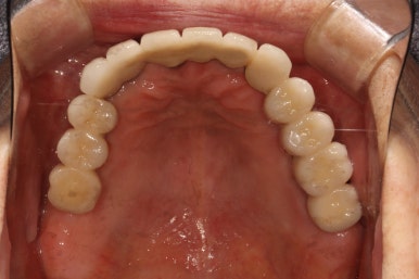 부분틀니를 오래써서 어금니가 아플 때, 아래턱 양쪽 어금니 임플란트 잘하는 강남임플란트치과 관련 이미지 31