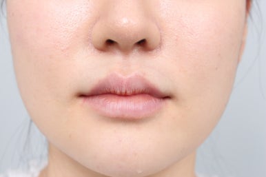 신사역 다른치과 앞니 라미네이트 하나 깨짐. 재치료 잘하는 레브치과의 레브네이트로 해결!! 관련 이미지 7
