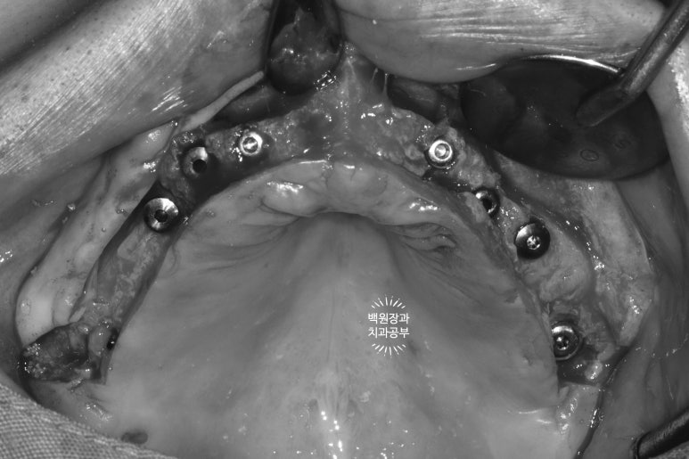 만성치주염으로 인해 아주 좁아진 잇몸뼈에 광범위한 뼈이식 + 전체임플란트. 신사 레브치과. 관련 이미지 28
