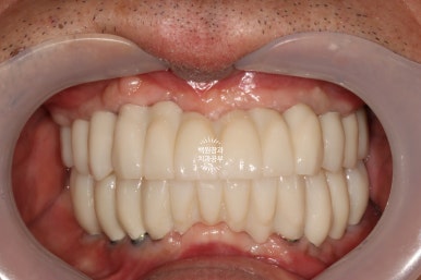 불편한 틀니를 아직도 쓰시나요? 전체 임플란트 치료비용/치료기간/치료과정. 관련 이미지 31