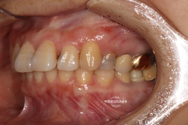 앞니레진치료 할 줄 모르는 치과의사는 없지만, 좋은 레진으로 치료하는 치과의사는 잘 없습니다. 관련 이미지 14