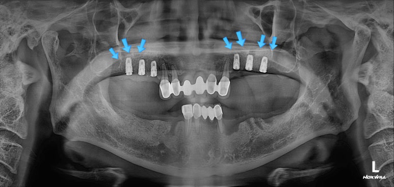 잇몸 염증 고름이 심했던 부위 - 만성치주염 진단하고 임플란트로 깔끔하게 치료! 신사역 치과 관련 이미지 17