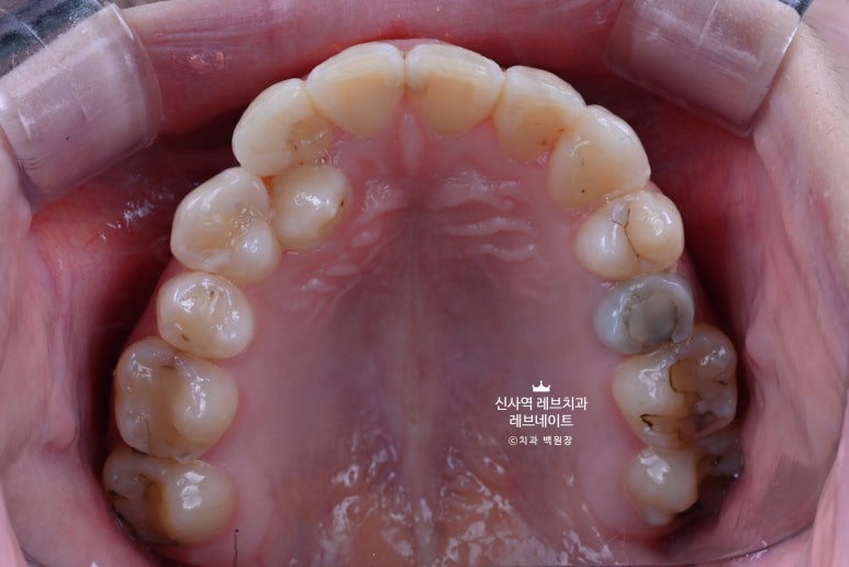 신사역 치과. 아나운서 면접 전 앞니 벌어진 공간을 라미네이트로만 해결할 수 있었던 사연.. 관련 이미지 25