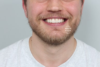 A European Patient at [Rev Dental Clinic] near Sinsa Station in Seoul Wanted Front Tooth Decay Treated with an EMAX All-Ceramic Crown. image 12