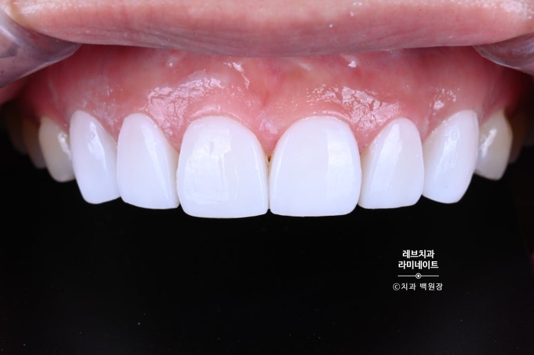 레브네이트 베이직. 치아미백과 치아교정을 한번에! 치아삭제 사진 있음. 신사역 치과 앞니라미네이트 모델/비용/후기. 관련 이미지 17