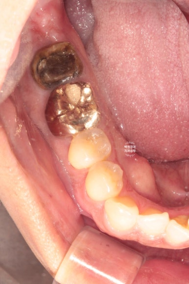 신경치료한 치아 부러짐! 뼈이식 하면서 임플란트 수술하는 과정/기간/비용. 관련 이미지 3