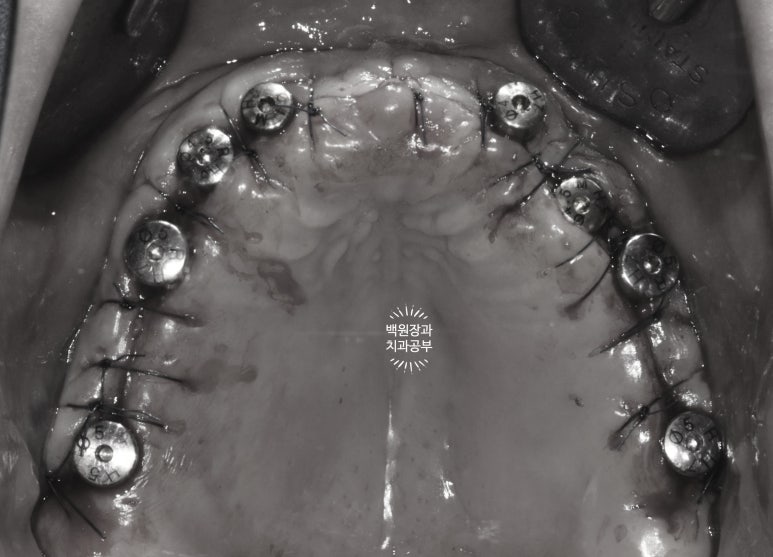 만성치주염으로 인해 아주 좁아진 잇몸뼈에 광범위한 뼈이식 + 전체임플란트. 신사 레브치과. 관련 이미지 42