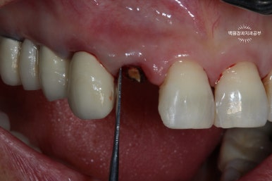 외과적 정출술 (surgical extrusion) - 치아를 살리는 마지막 방법. 치료과정/치료기간/비용/사진. 관련 이미지 4