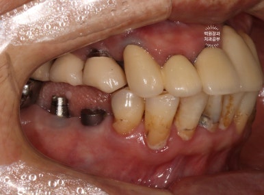 스트라우만 임플란트로 이뽑고 바로심는치과 - 믿고 사용하는 세계 1위 스위스 임플란트 회사. 관련 이미지 14