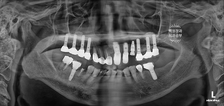 스트라우만 임플란트로 이뽑고 바로심는치과 - 믿고 사용하는 세계 1위 스위스 임플란트 회사. 관련 이미지 9