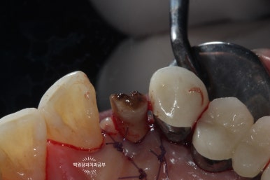 외과적 정출술 (surgical extrusion) - 치아를 살리는 마지막 방법. 치료과정/치료기간/비용/사진. 관련 이미지 7