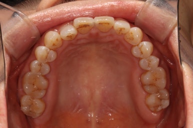 치아크랙 (금간 치아)의 찌릿한 통증 - 발치하지 않고 살려보기. 원인/진단/치료과정/비용/기간. 보존과전문의 치과. 관련 이미지 6