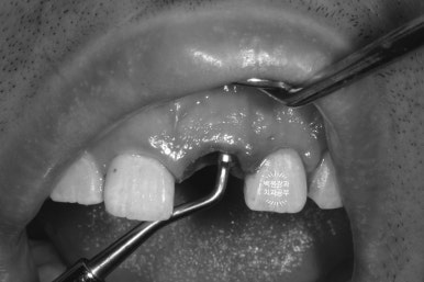 앞니 머리가 기둥째 부러졌어요. 발치 동시 뼈이식 오스템 BA 임플란트. 치료과정/치료기간/비용/후기. 압구정 치과. 관련 이미지 10